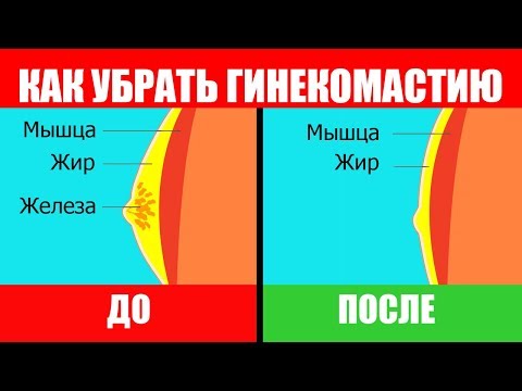 Гинекомастия у Мужчин. Как Избавиться Без Операции. Гина