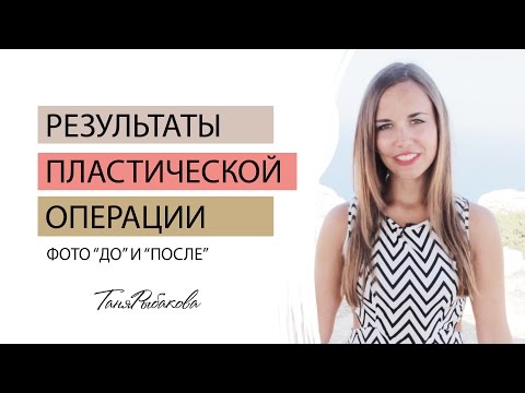 До и после пластической операции по подтяжке кожи. Мои результаты и фото.